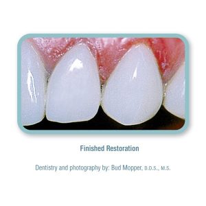 کامپوزیت پینک اپک کازمادنت / Cosmedent Creative Color Pink Opaque