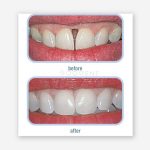 کامپوزیت رنگ لثه رنامل کازمادنت / Cosmedent Renamel Gingafill Composite