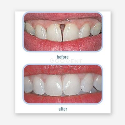 کامپوزیت رنگ لثه رنامل کازمادنت / Cosmedent Renamel Gingafill Composite