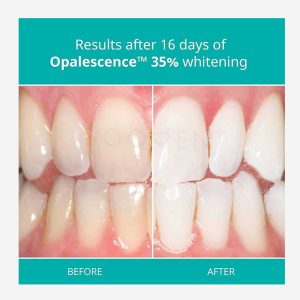ژل بلیچینگ اوپال سنس اولترادنت Ultradent Opalescence