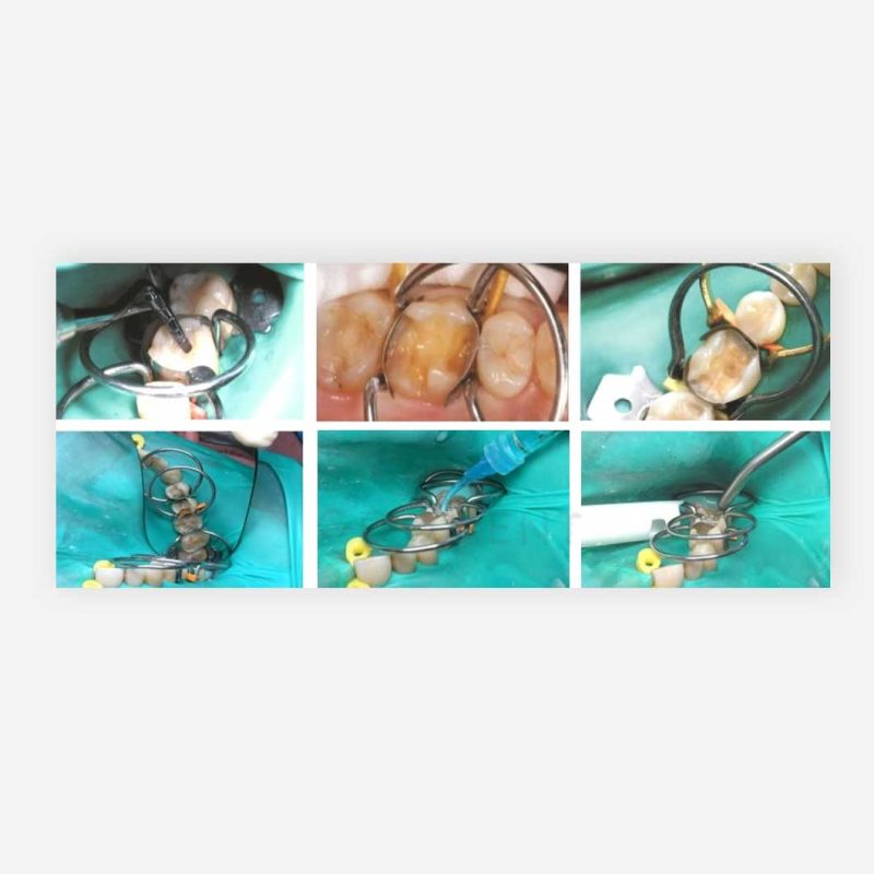 کیت کلمپ سکشنال ماتریکس Tor VM Clamp Ring Set 1.399